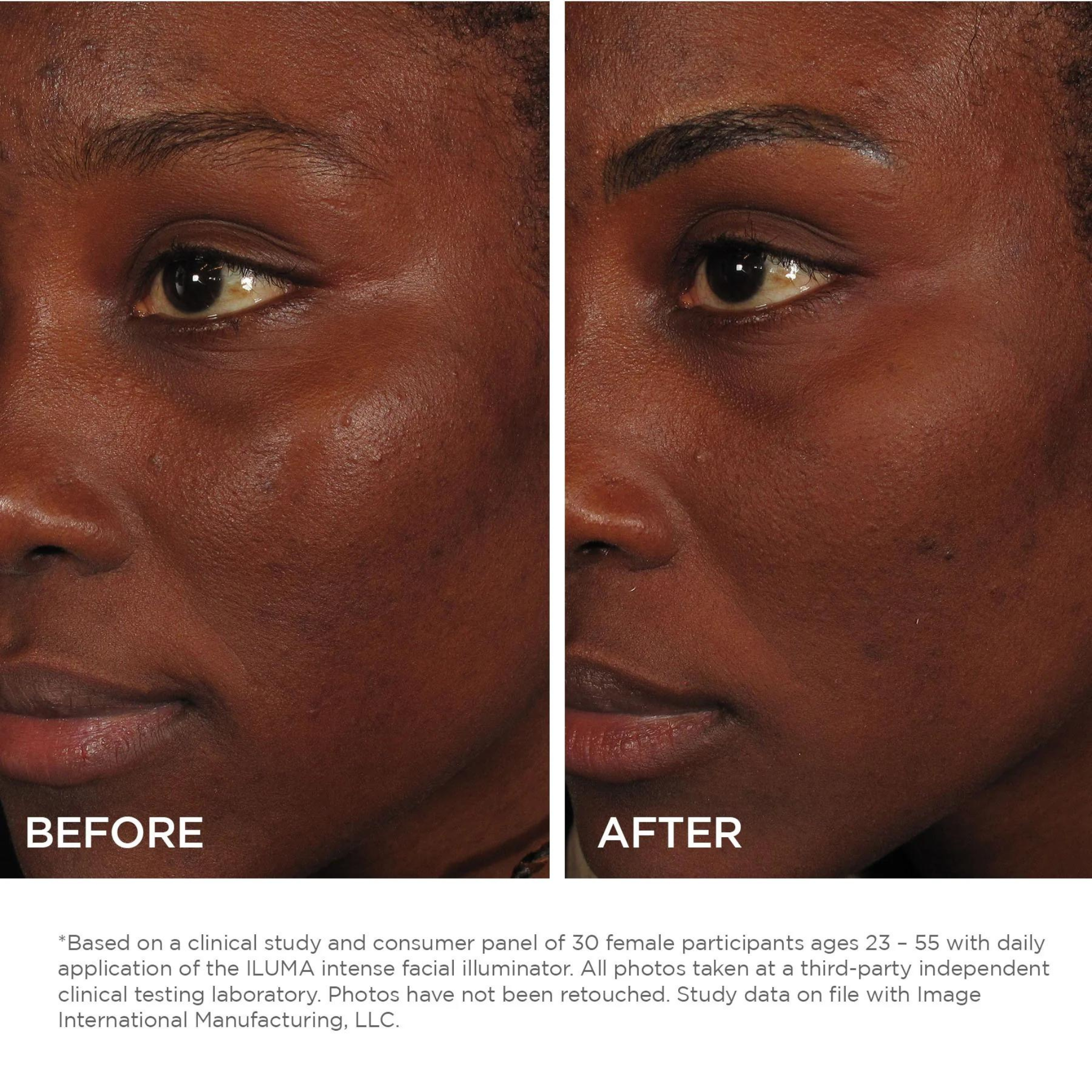ILUMA® Intense Facial Illuminator | IMAGE Skincare